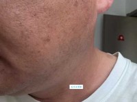 醋精和白面祛斑的方法靠谱吗 醋精加白面祛斑需要几小时